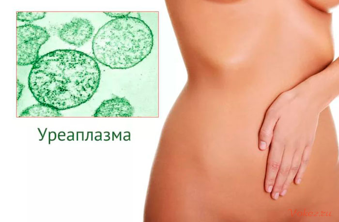 Уреаплазма у женщин
