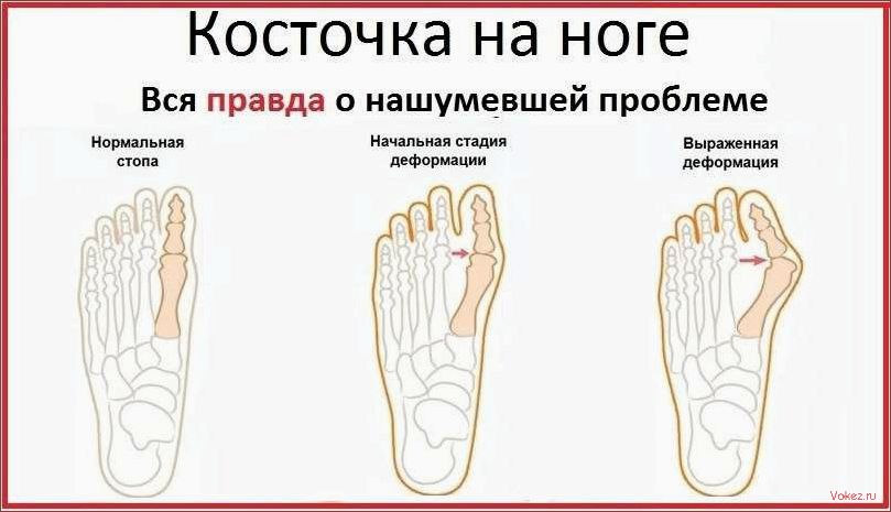 (выпирающая, косточка, большом, пальце, ноги) Выпирающая косточка на большом пальце ноги — самое распространенное заболевание стоп у женщин Как удалить косточку на ноге