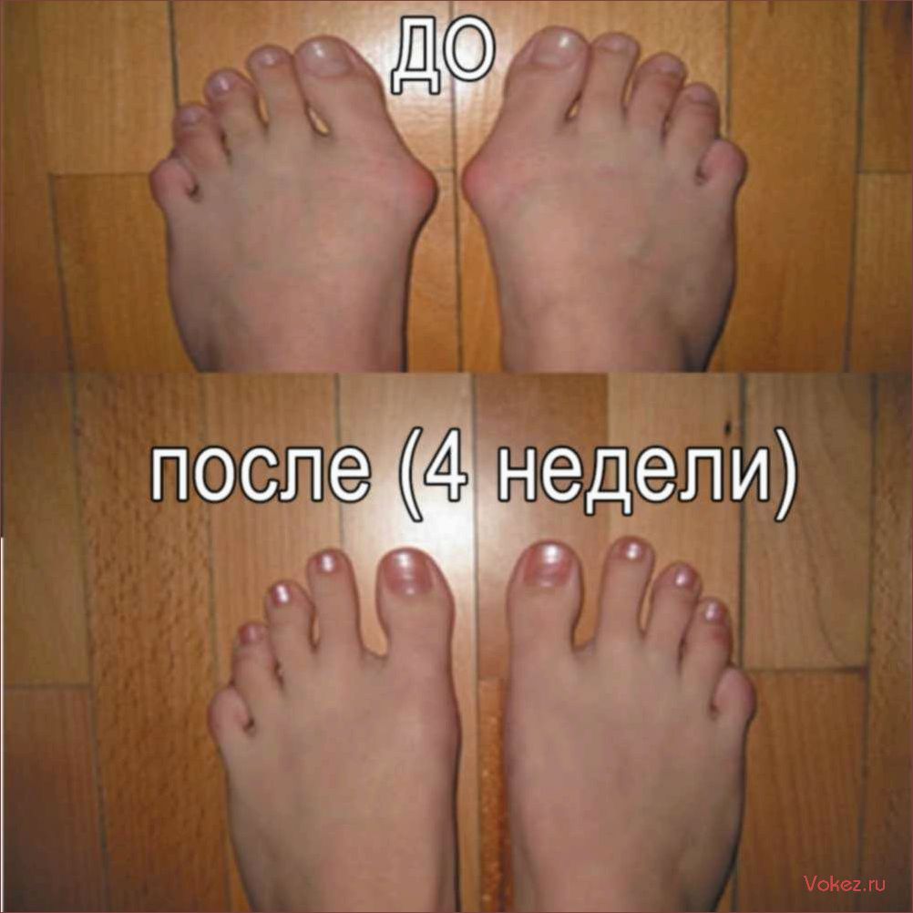 (выпирающая, косточка, большом, пальце, ноги) Выпирающая косточка на большом пальце ноги — самое распространенное заболевание стоп у женщин Как удалить косточку на ноге