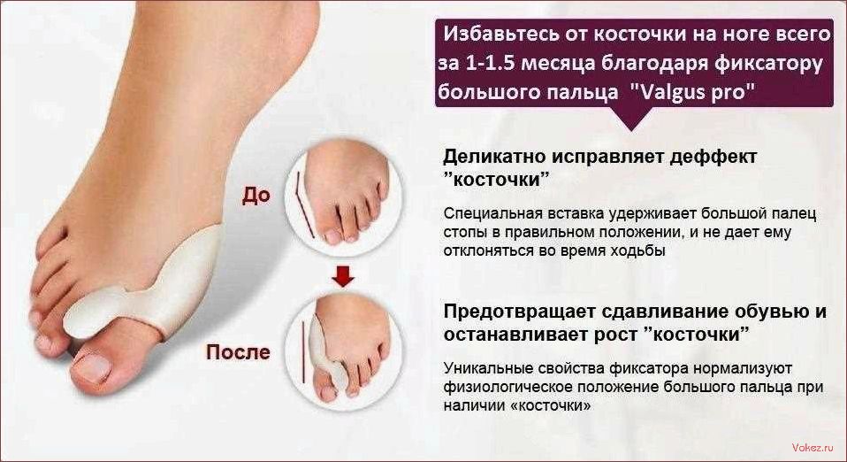 (выпирающая, косточка, большом, пальце, ноги) Выпирающая косточка на большом пальце ноги — самое распространенное заболевание стоп у женщин Как удалить косточку на ноге
