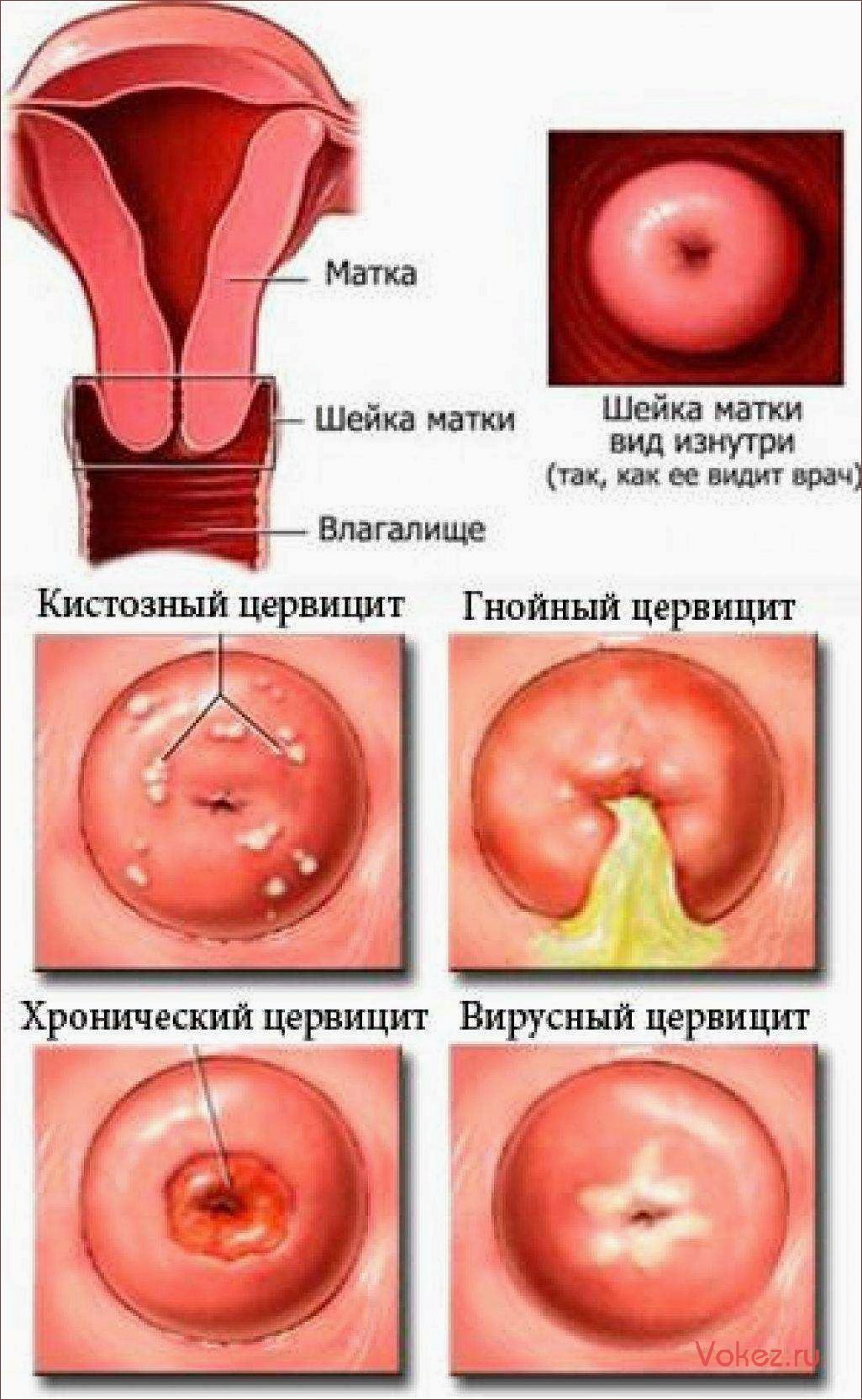 (эрозия, шейки, матки, симптомы, причины) Эрозия шейки матки — симптомы, причины и лечение. Прижигание эрозии матки — ответы от акушера-гинеколога